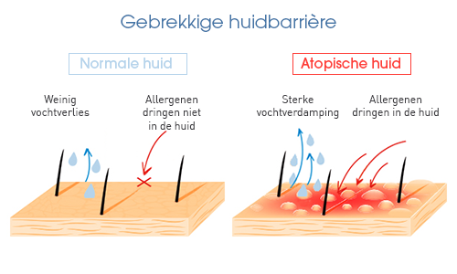 Atopische huid