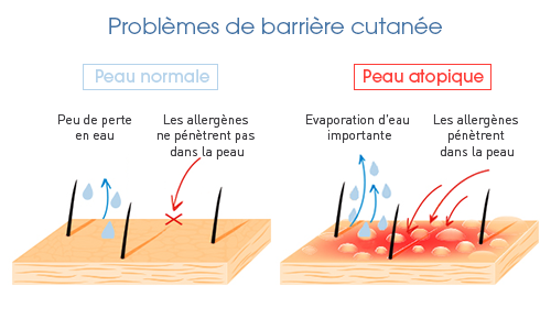 hypersensibilité de la peau