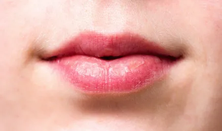 gesprongen lippen