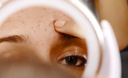 Une femme avec un problème de dysséborrhée