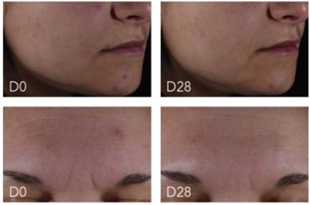 Transformative Results: Before and After Photos with Sébium Serum