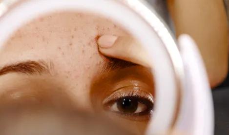 Une femme avec un problème de dysséborrhée