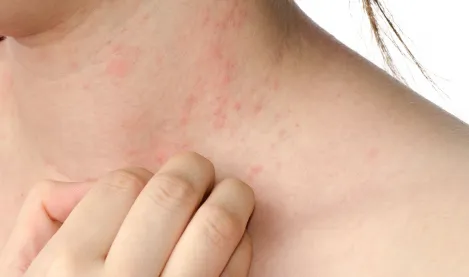 Eczema on the neck